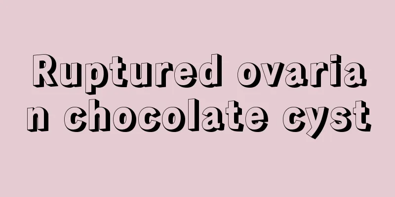 Ruptured ovarian chocolate cyst
